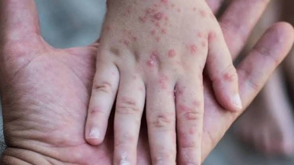 ABD'de Kızamık Vakaları 35 Yılın Zirvesinde